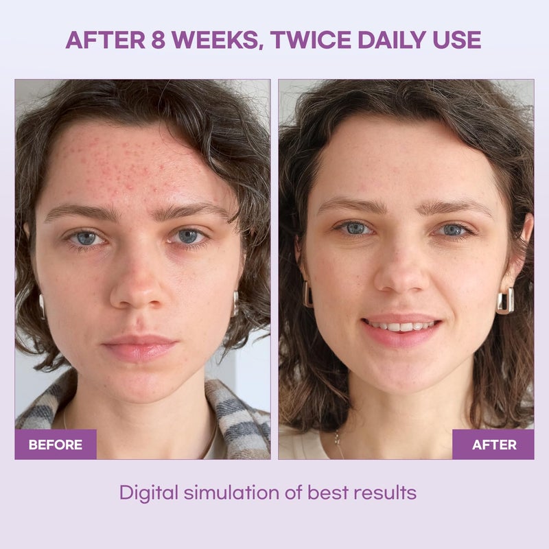 Natural Vine Dark Spot Serum: Dark Spot Remover for Face with Grape Extract, Fermentation Complex, Hyaluronic Acid & Vitamin E, 1 FL OZ / 30mL - Image 3